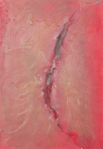 Cauterise