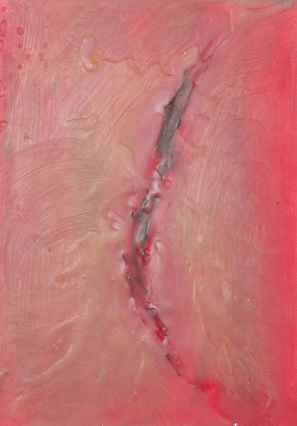 Cauterise